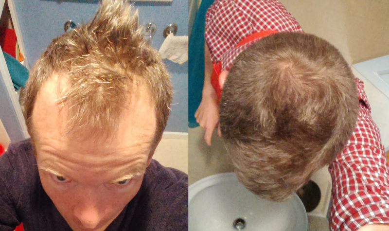 How I Thickened My Hair and Advanced My Hairline with a Simple Massage  Technique (and no Drugs) . Moyer
